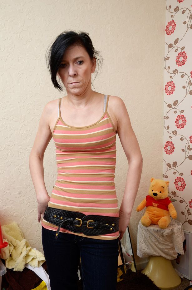 脂肪異栄養症(リポジストロフィー) 【閲覧注意】奇形・奇病・難病～人体の驚異 NAVER まとめ